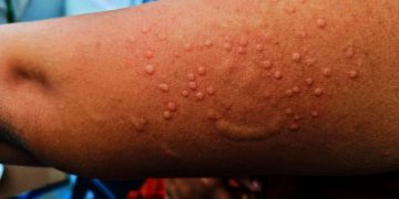 എം പോക്‌സ്; ഇന്ത്യ പേടിക്കണോ?